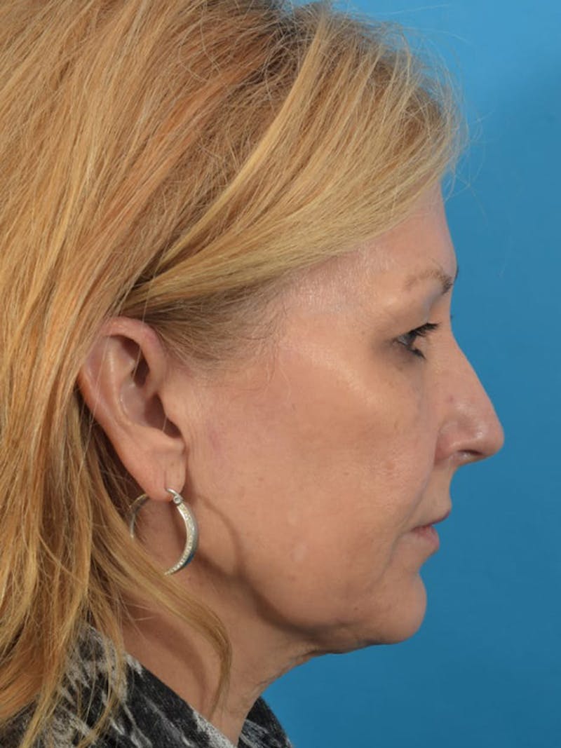 Laser Treatment Before & After Gallery - Patient 40749736 - Image 5
