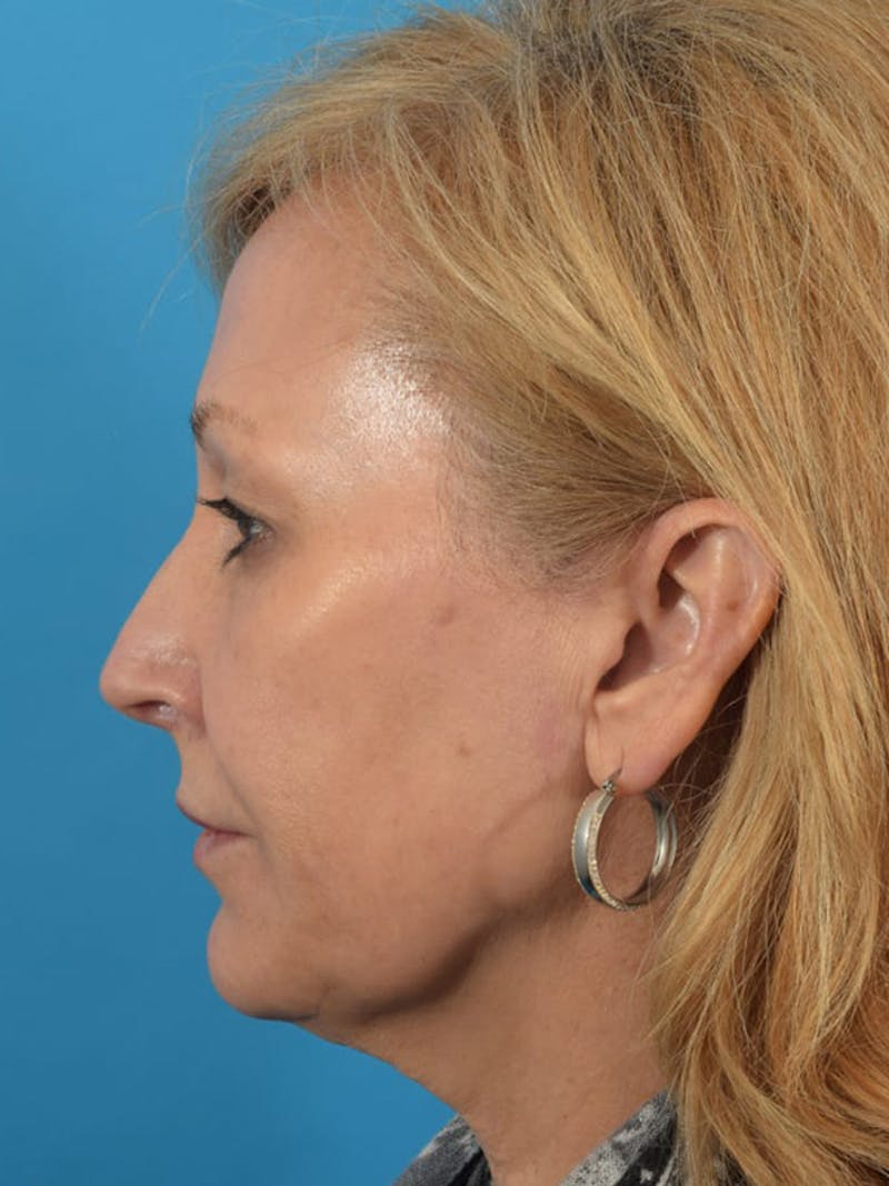 Laser Treatment Before & After Gallery - Patient 40749736 - Image 9