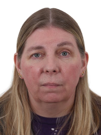 Blepharoplasty Before & After Gallery - Patient 549107 - Image 1