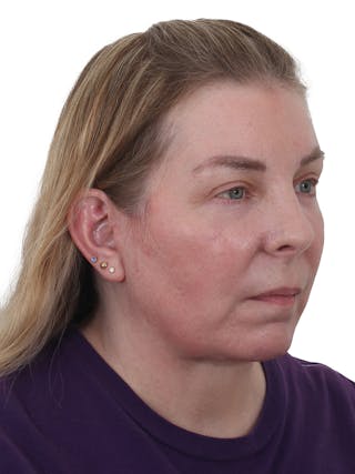 Facelift/Neck Lift Before & After Gallery - Patient 917157 - Image 4