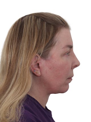 Facelift/Neck Lift Before & After Gallery - Patient 917157 - Image 6