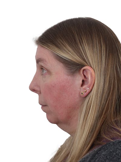 Chin Augmentation Before & After Gallery - Patient 302497 - Image 1