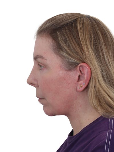 Chin Augmentation Before & After Gallery - Patient 302497 - Image 2