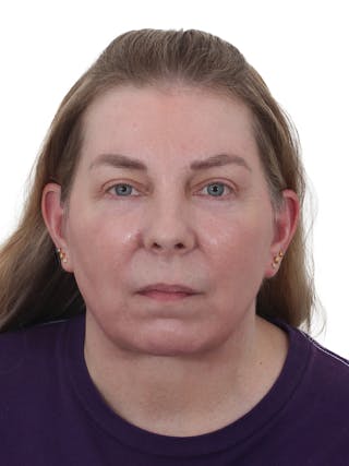 Facelift/Neck Lift Before & After Gallery - Patient 917157 - Image 2
