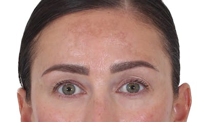 Blepharoplasty Before & After Gallery - Patient 346859 - Image 1