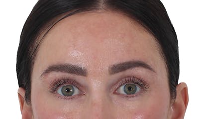 Blepharoplasty Before & After Gallery - Patient 346859 - Image 2