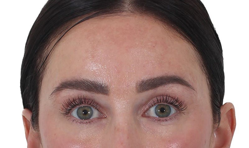 Blepharoplasty Before & After Gallery - Patient 346859 - Image 2