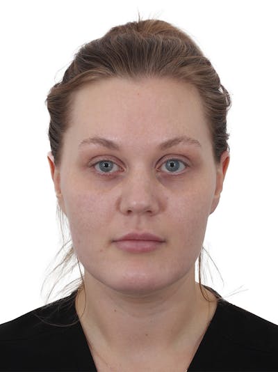 Buccal Fat Reduction Before & After Gallery - Patient 268114 - Image 1