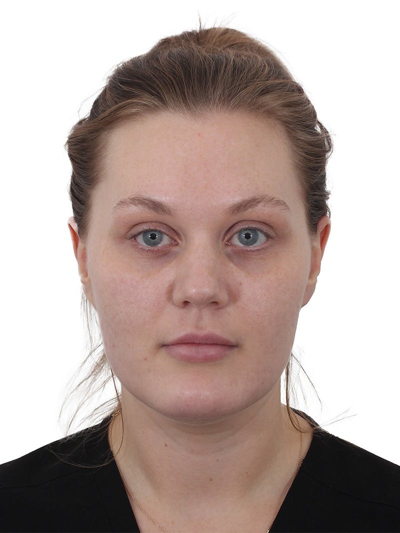 Buccal Fat Reduction Before & After Gallery - Patient 268114 - Image 1
