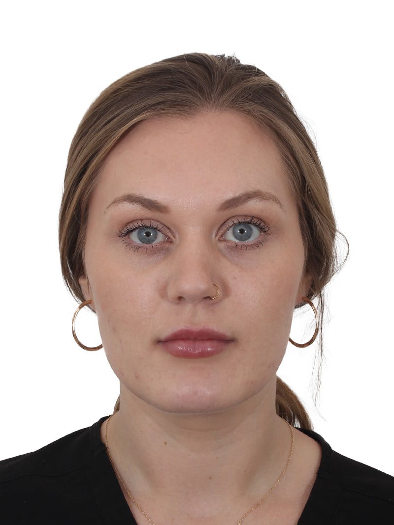 Buccal Fat Reduction Before & After Gallery - Patient 268114 - Image 2