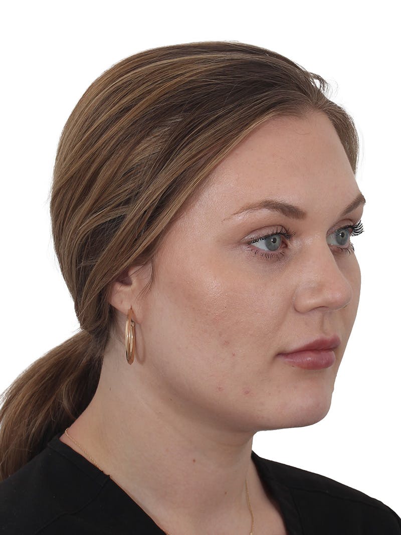 Buccal Fat Reduction Before & After Gallery - Patient 268114 - Image 4