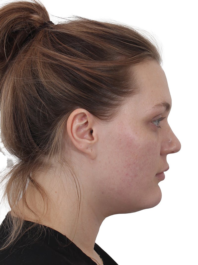 Submental Liposuction Before & After Gallery - Patient 765571 - Image 11
