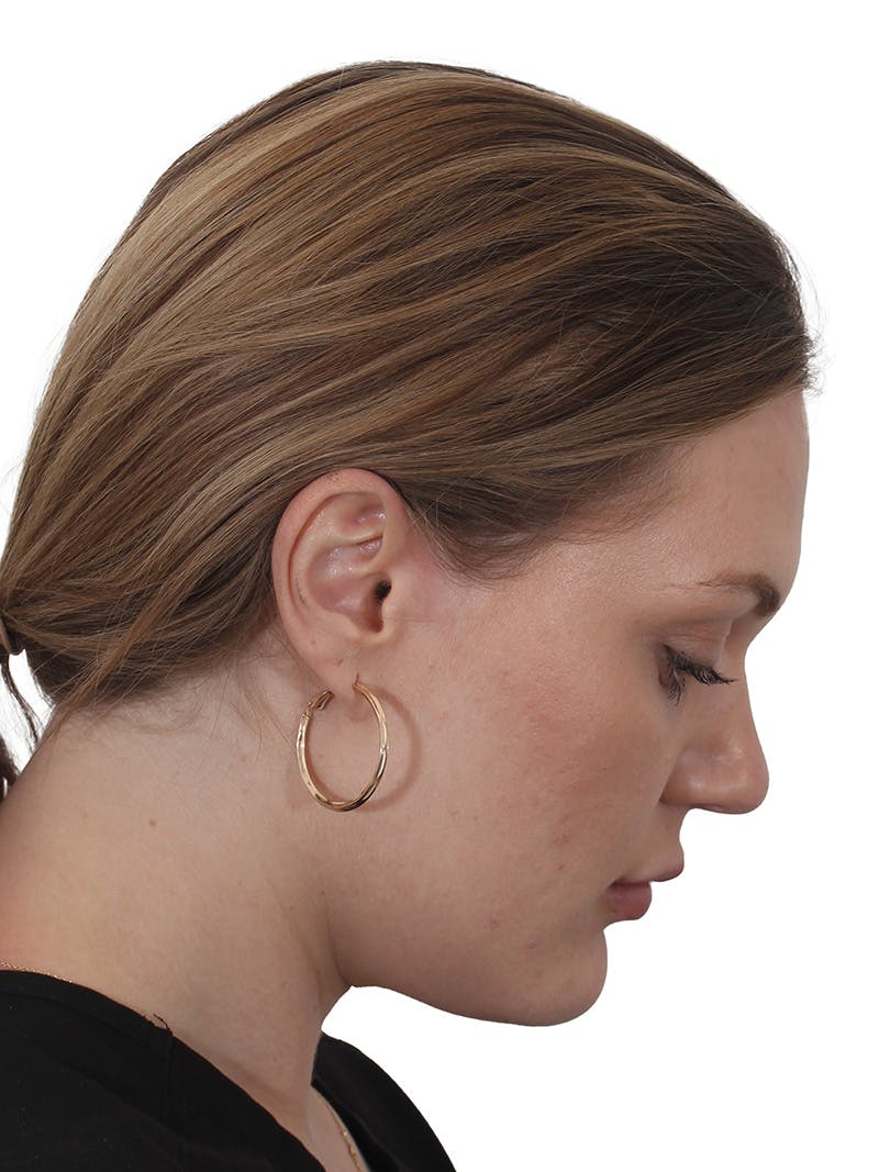 Submental Liposuction Before & After Gallery - Patient 765571 - Image 14