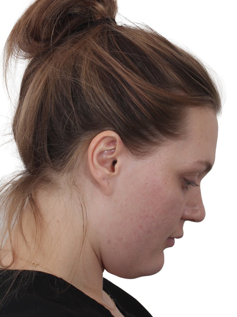 Submental Liposuction Before & After Gallery - Patient 765571 - Image 13