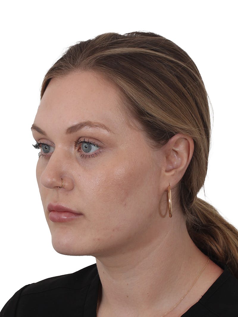 Buccal Fat Reduction Before & After Gallery - Patient 268114 - Image 6