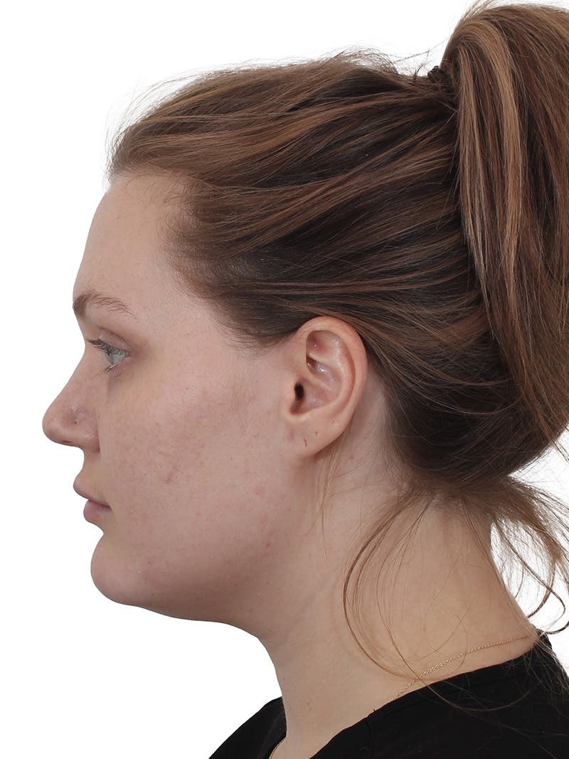 Submental Liposuction Before & After Gallery - Patient 765571 - Image 1