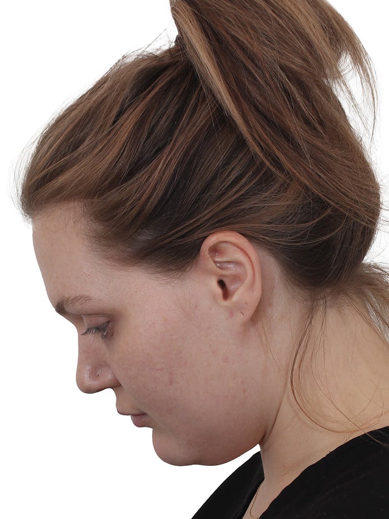Submental Liposuction Before & After Gallery - Patient 765571 - Image 3
