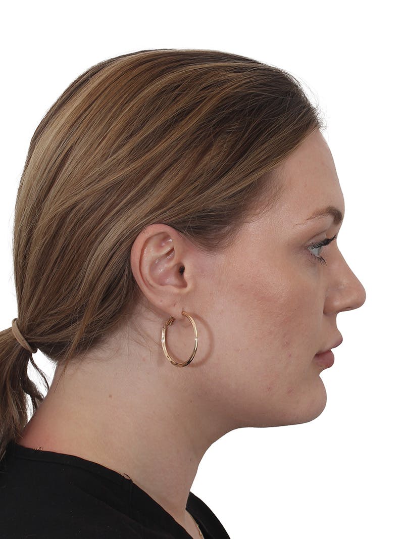 Submental Liposuction Before & After Gallery - Patient 765571 - Image 12