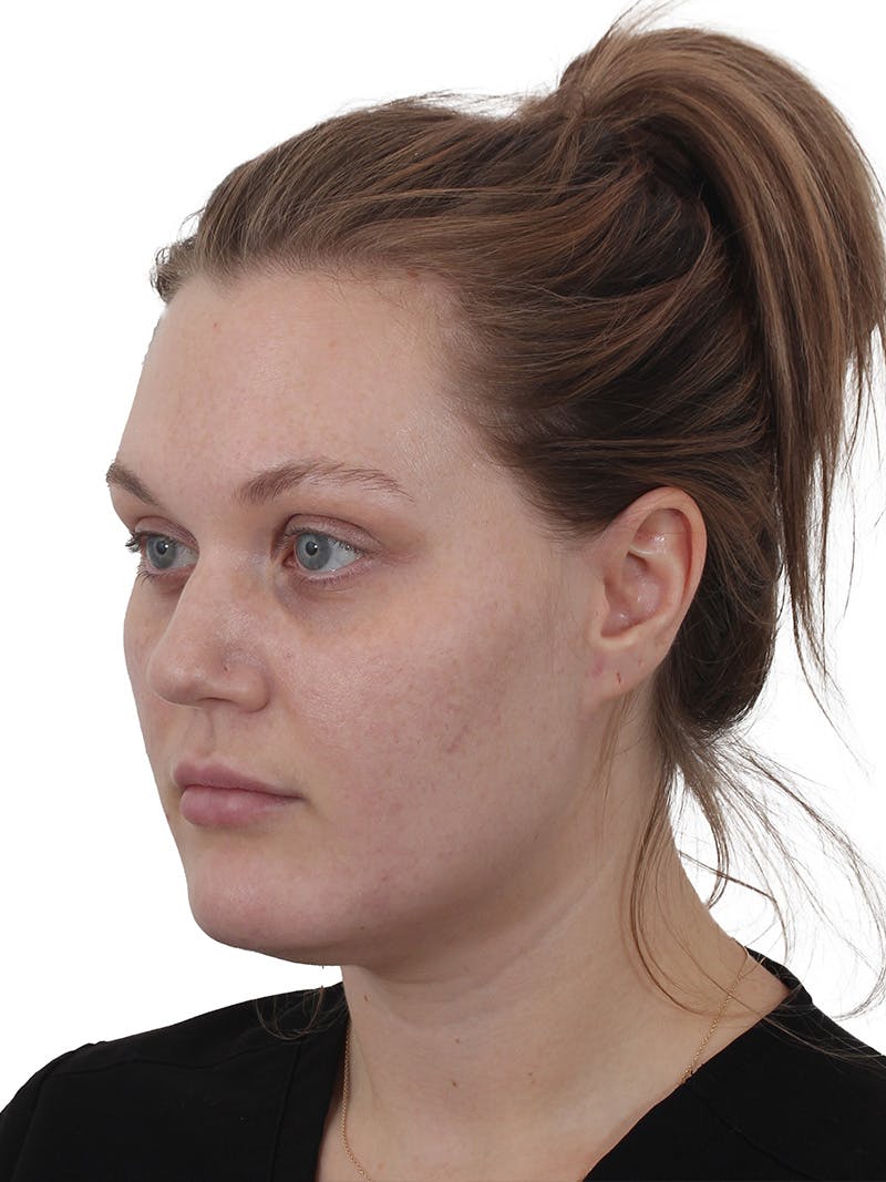 Buccal Fat Reduction Before & After Gallery - Patient 268114 - Image 5