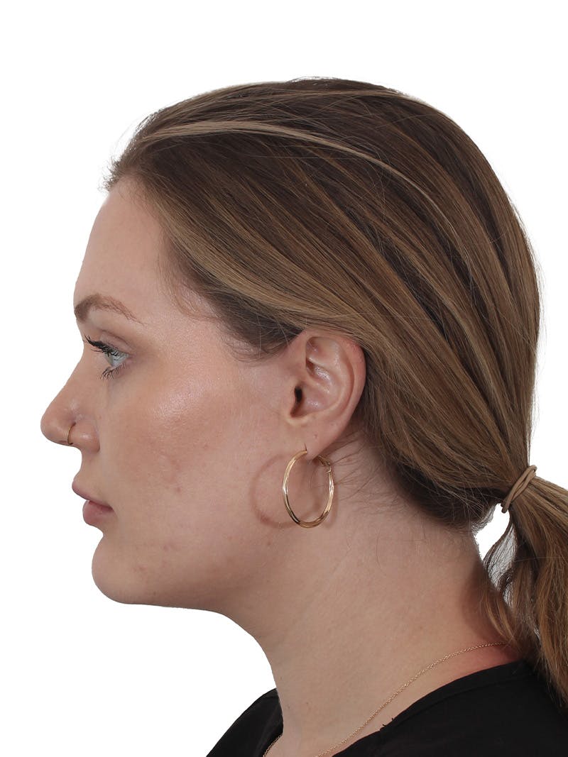 Submental Liposuction Before & After Gallery - Patient 765571 - Image 2
