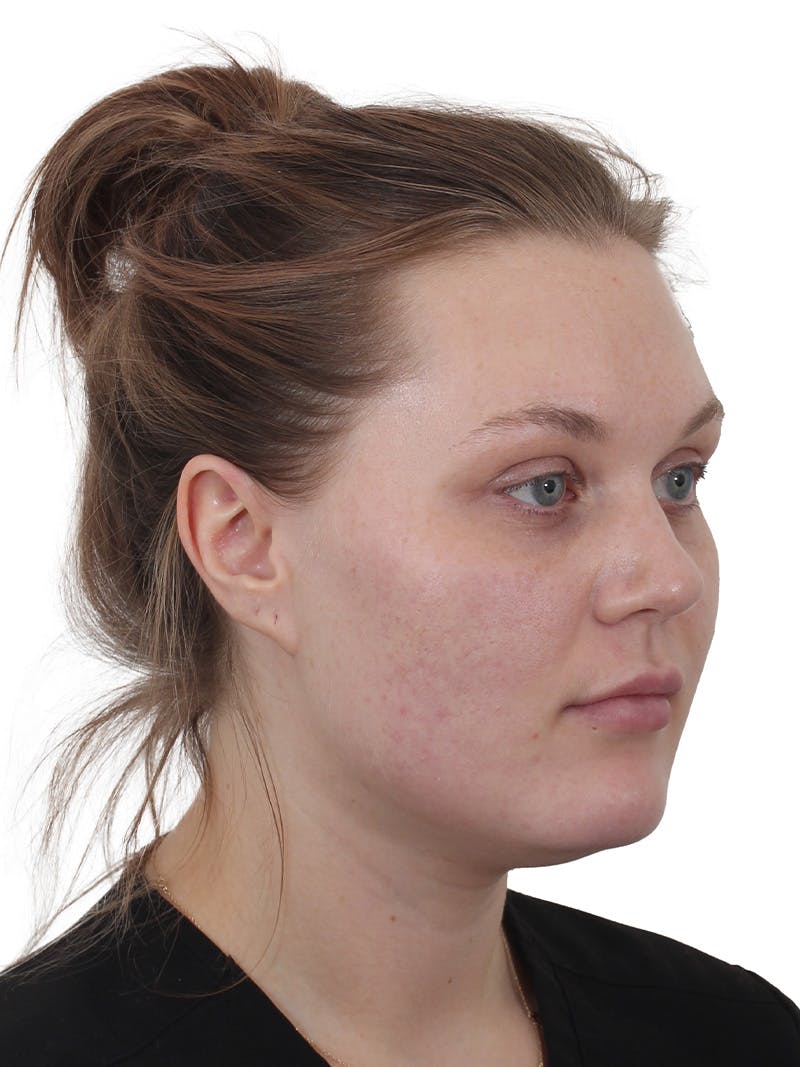 Buccal Fat Reduction Before & After Gallery - Patient 268114 - Image 3