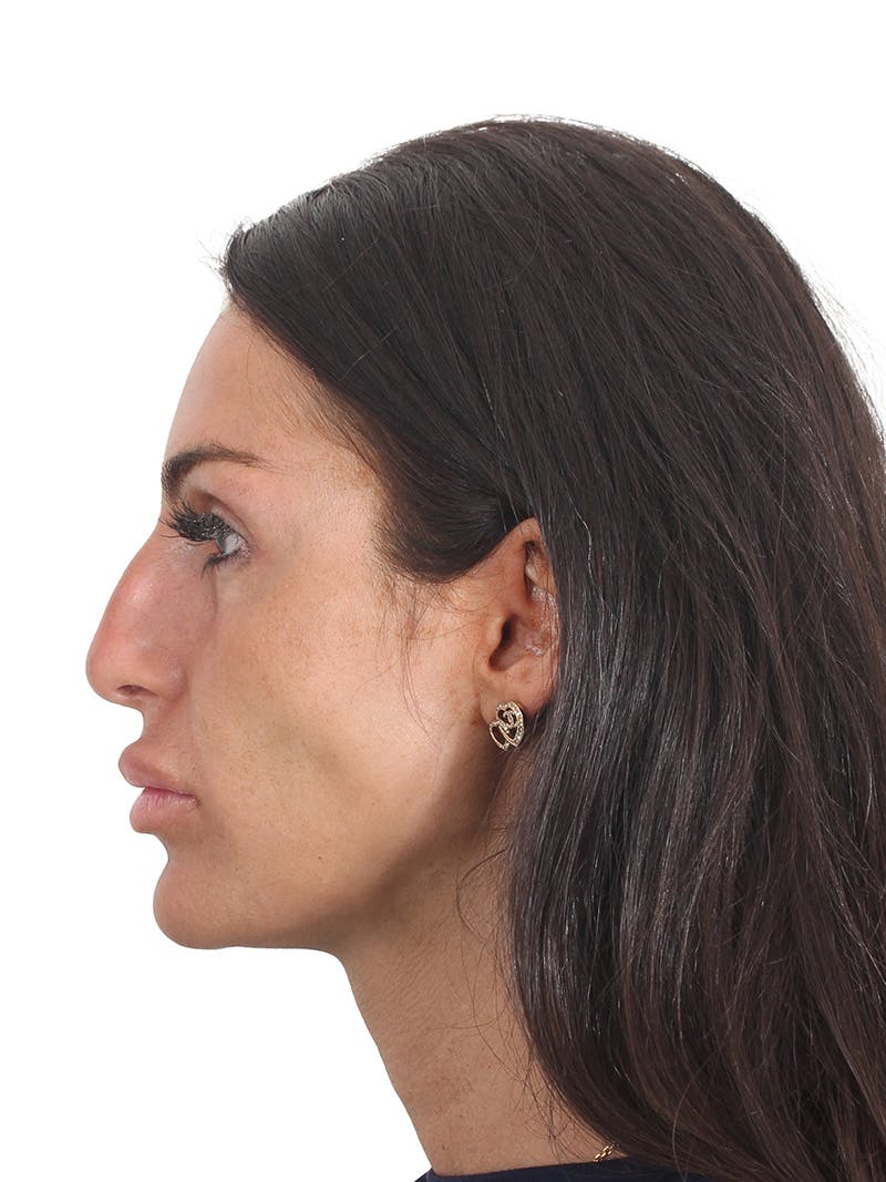 Rhinoplasty Before & After Gallery - Patient 239051 - Image 3