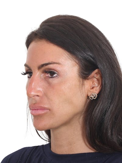 Rhinoplasty Before & After Gallery - Patient 239051 - Image 1