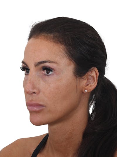 Rhinoplasty Before & After Gallery - Patient 239051 - Image 2