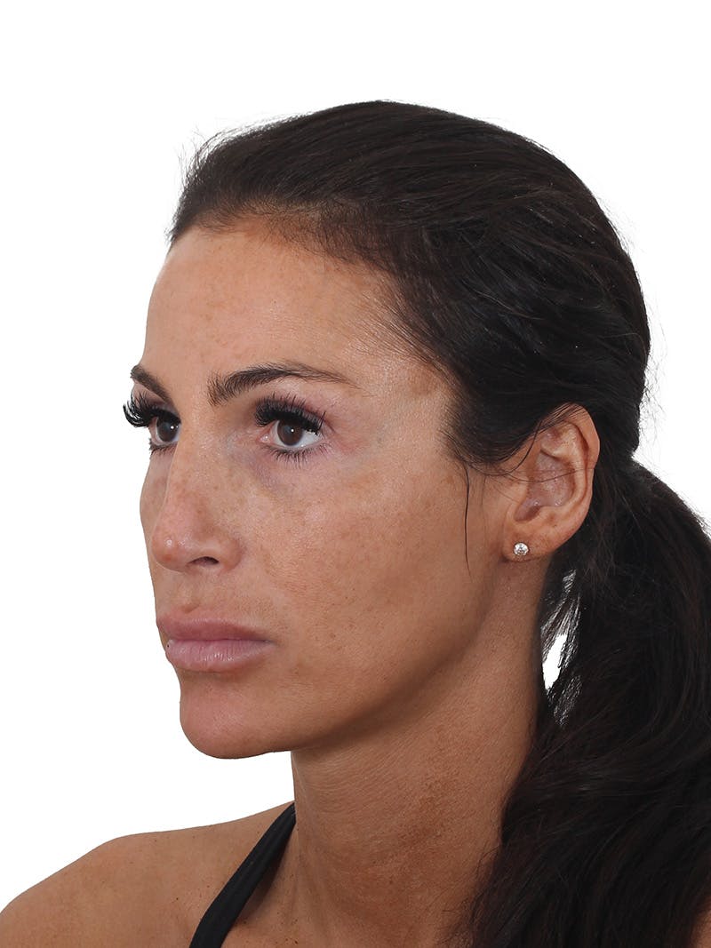 Rhinoplasty Before & After Gallery - Patient 239051 - Image 2