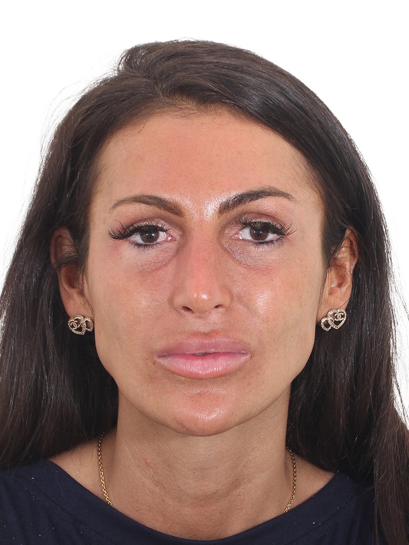 Rhinoplasty Before & After Gallery - Patient 239051 - Image 5