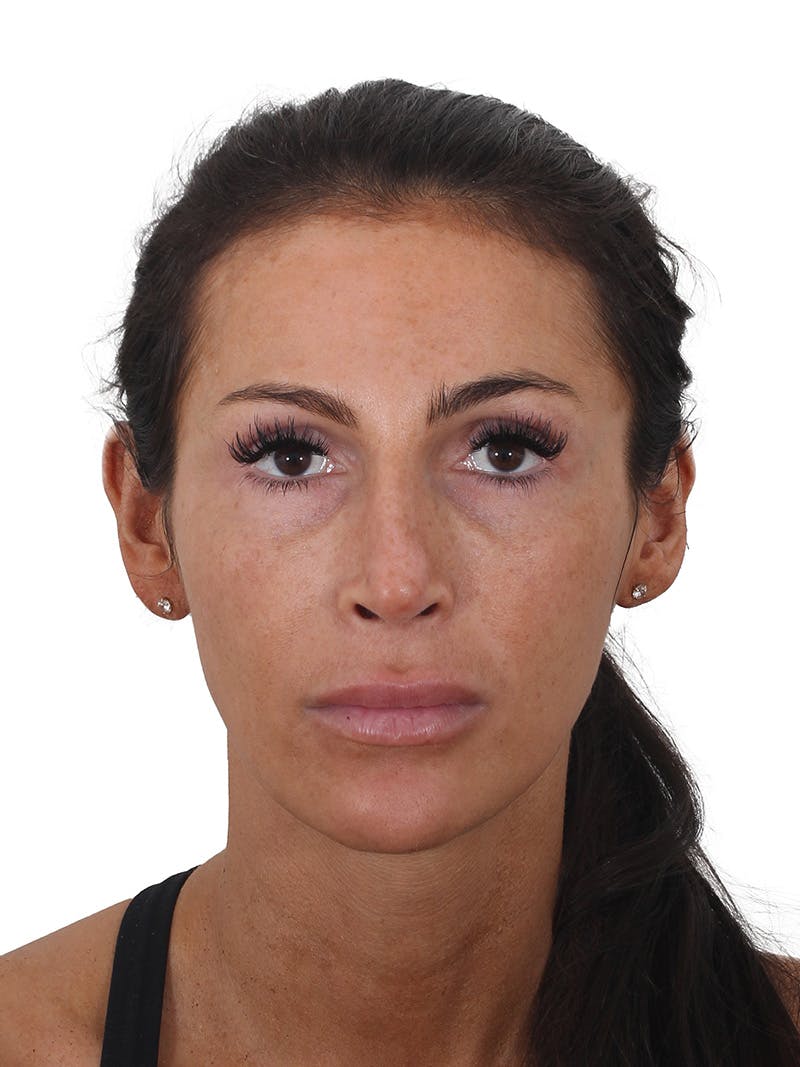Rhinoplasty Before & After Gallery - Patient 239051 - Image 6