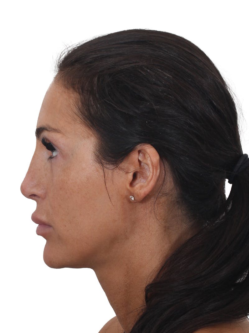 Rhinoplasty Before & After Gallery - Patient 239051 - Image 4