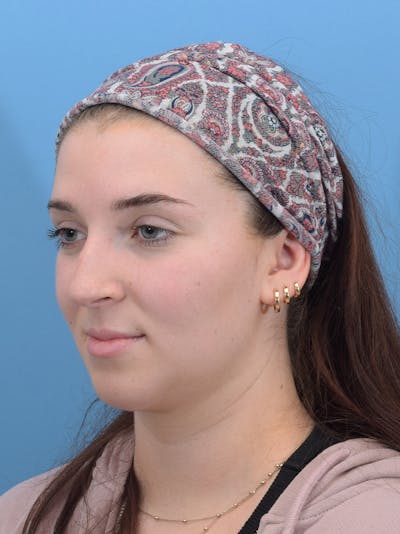 Rhinoplasty Before & After Gallery - Patient 293405 - Image 1