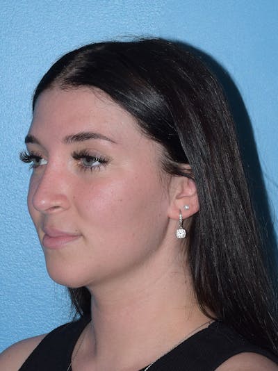 Rhinoplasty Before & After Gallery - Patient 293405 - Image 2