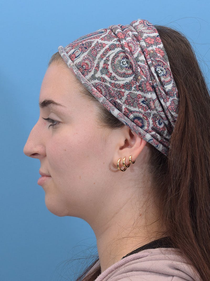 Rhinoplasty Before & After Gallery - Patient 293405 - Image 3