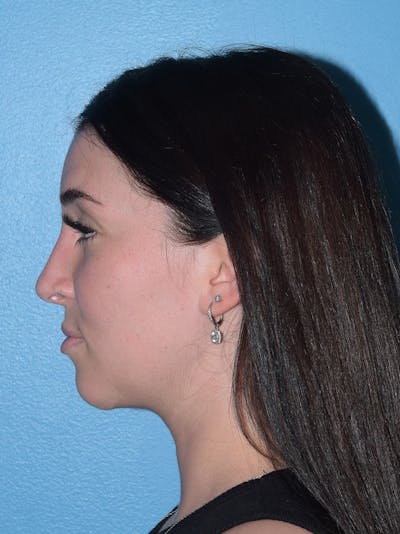 Rhinoplasty Before & After Gallery - Patient 293405 - Image 2