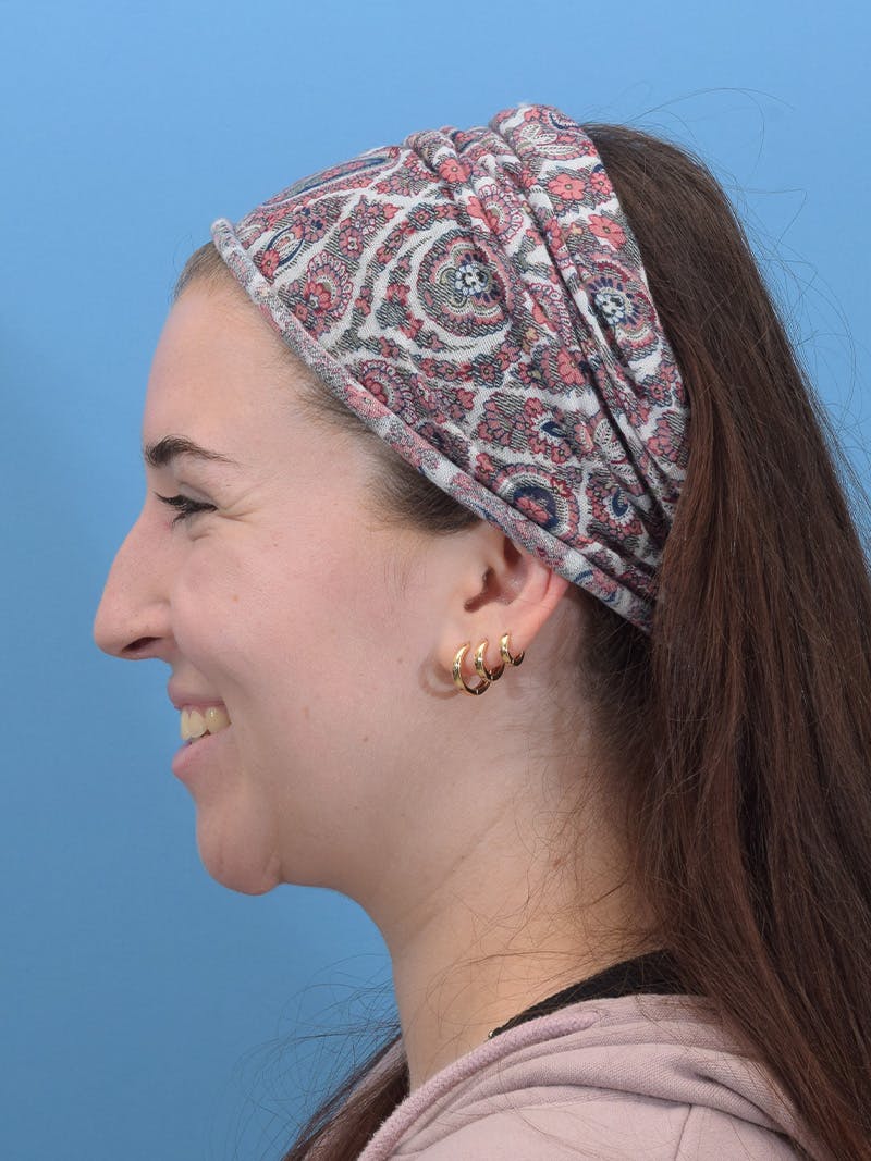 Rhinoplasty Before & After Gallery - Patient 293405 - Image 6