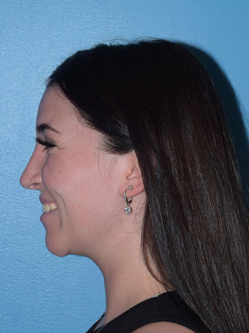 Rhinoplasty Before & After Gallery - Patient 293405 - Image 5