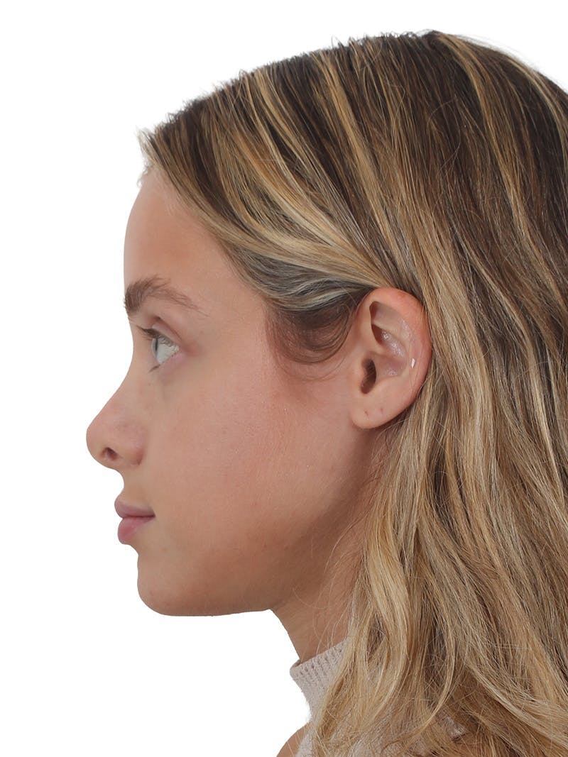 Rhinoplasty Before & After Gallery - Patient 409018 - Image 1