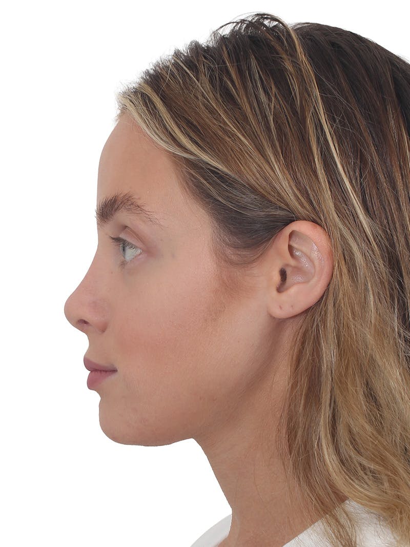 Rhinoplasty Before & After Gallery - Patient 409018 - Image 2