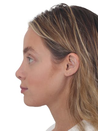 Rhinoplasty Before & After Gallery - Patient 409018 - Image 2