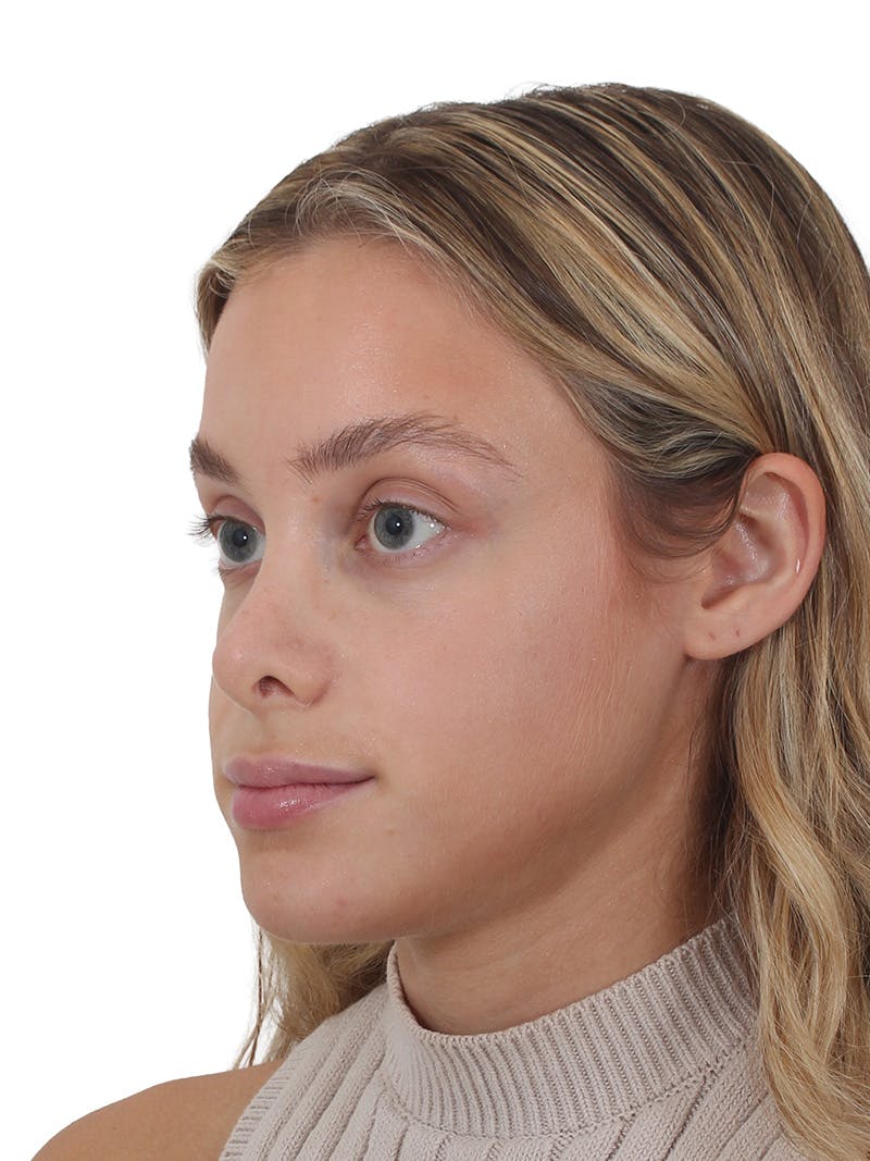 Rhinoplasty Before & After Gallery - Patient 409018 - Image 3