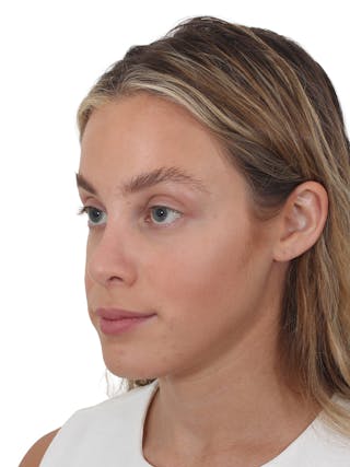 Rhinoplasty Before & After Gallery - Patient 409018 - Image 4