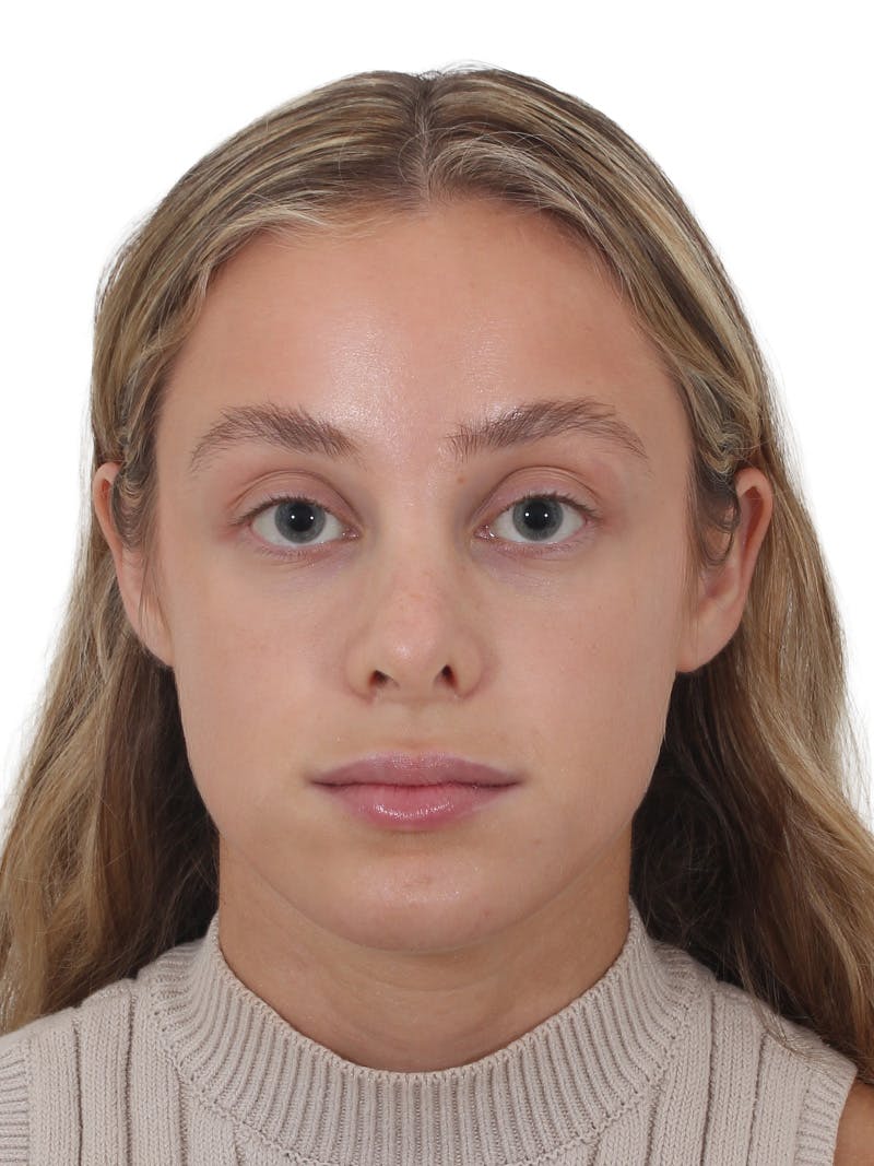 Rhinoplasty Before & After Gallery - Patient 409018 - Image 5