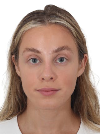 Rhinoplasty Before & After Gallery - Patient 409018 - Image 6