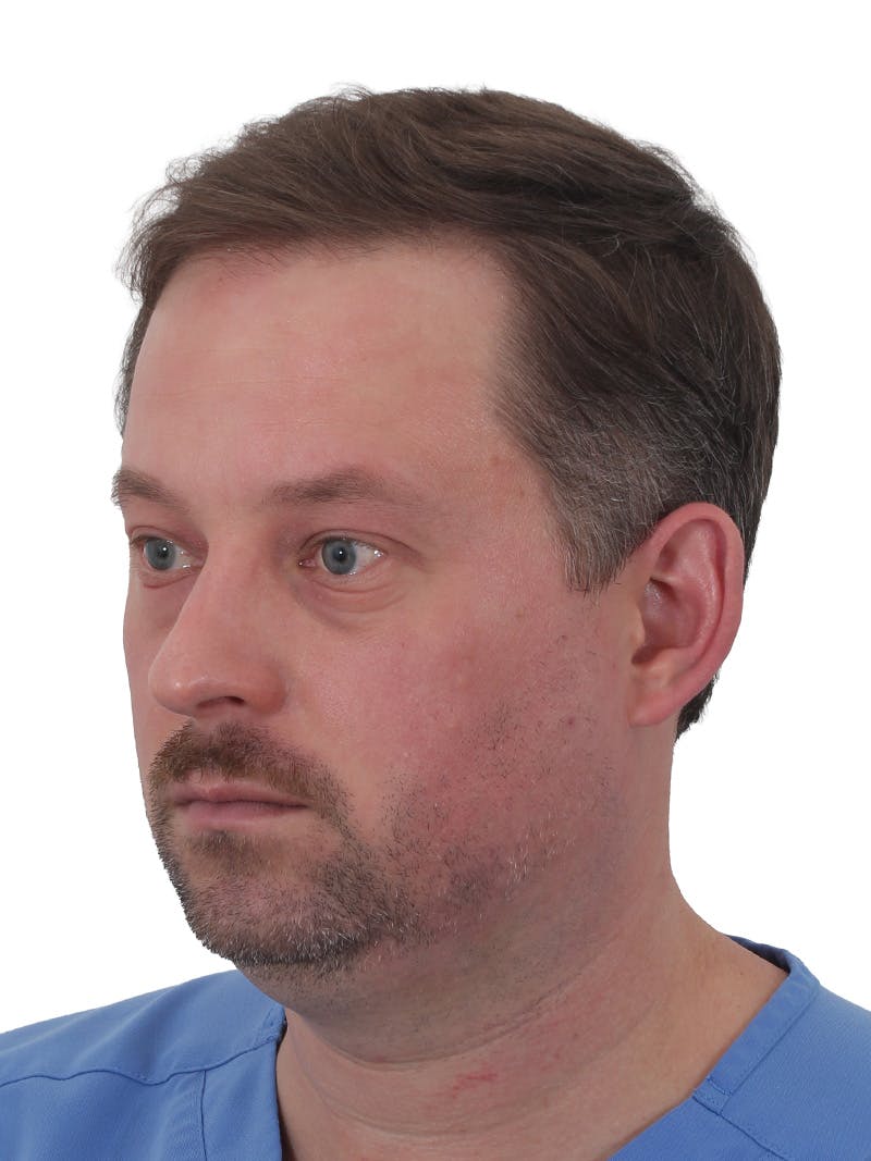 Facelift/Neck Lift Before & After Gallery - Patient 366161 - Image 9