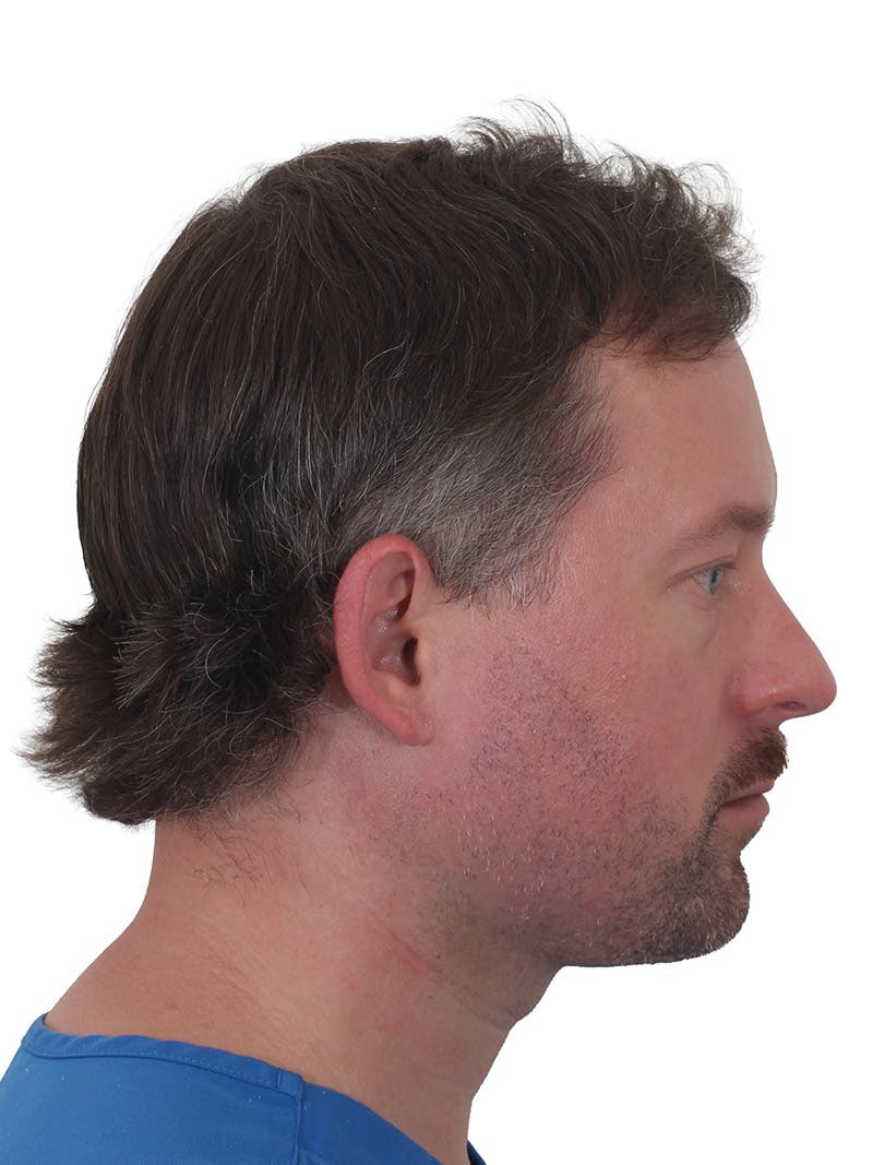 Facelift/Neck Lift Before & After Gallery - Patient 366161 - Image 2