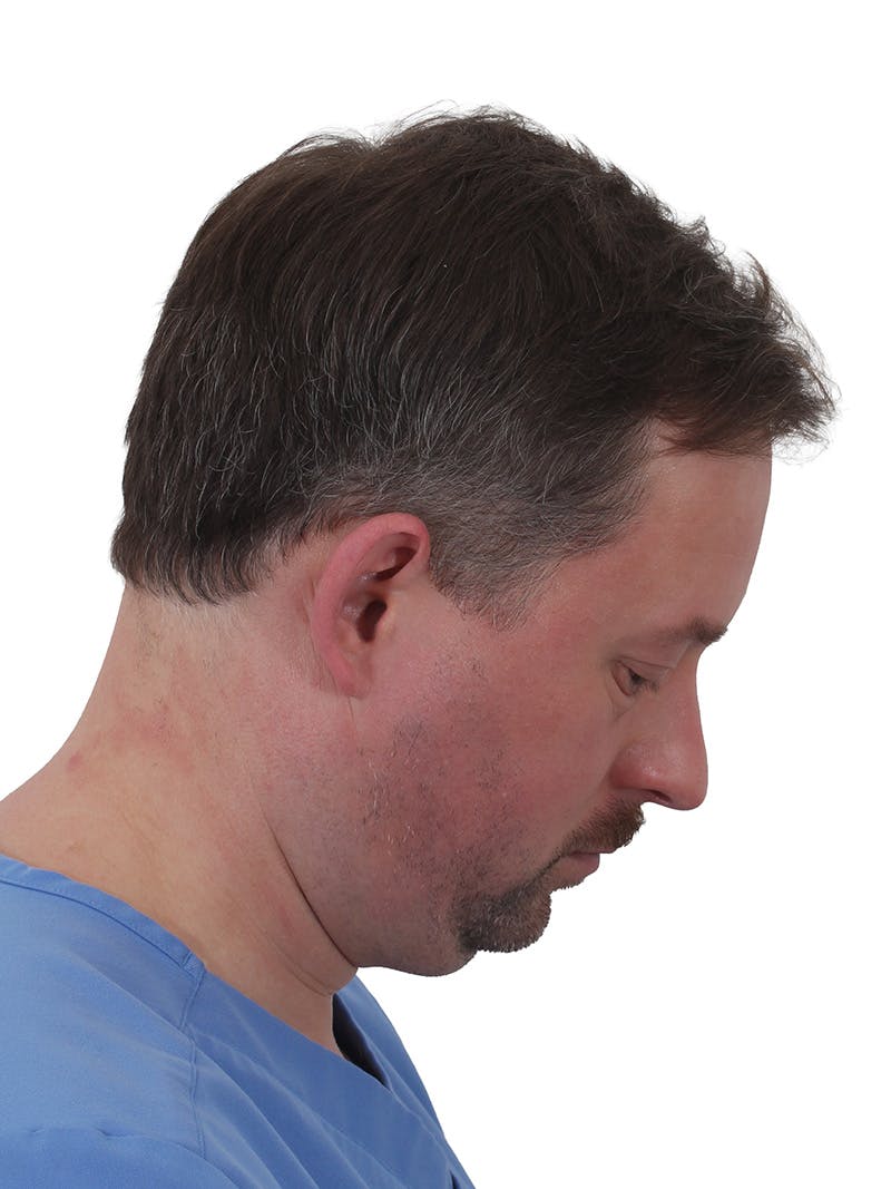 Facelift/Neck Lift Before & After Gallery - Patient 366161 - Image 7