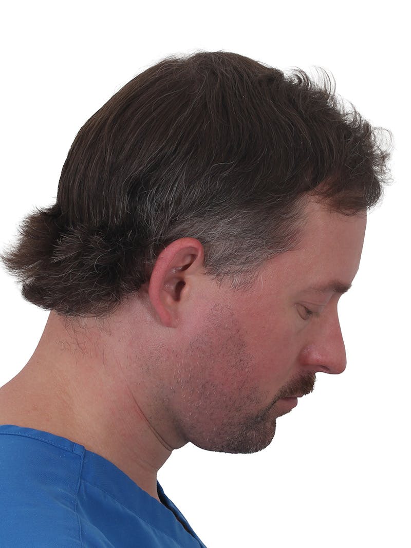 Facelift/Neck Lift Before & After Gallery - Patient 366161 - Image 8