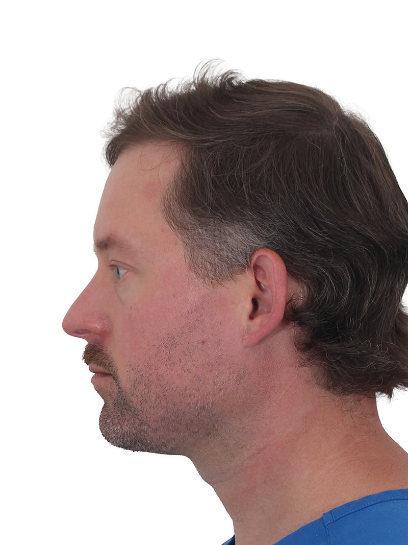 Facelift/Neck Lift Before & After Gallery - Patient 366161 - Image 6